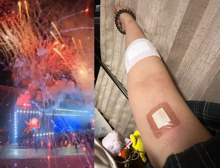 SEVENTEEN演唱會施放大量煙火，粉絲遭火苗波及受傷。翻攝粉絲X