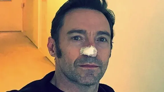 澳洲男星休傑克曼曾透露患皮膚癌。