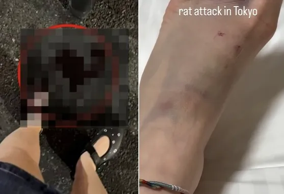 女子腳背被老鼠咬傷。翻攝自IG