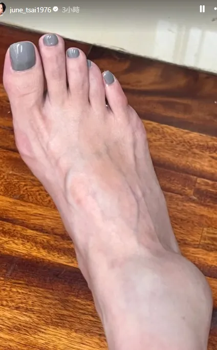 六月腳踝腫得很嚴重。翻攝六月IG