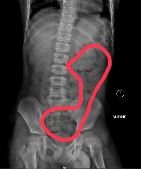 11歲男生X光片，畫圈部分為積糞。翻攝畫面
