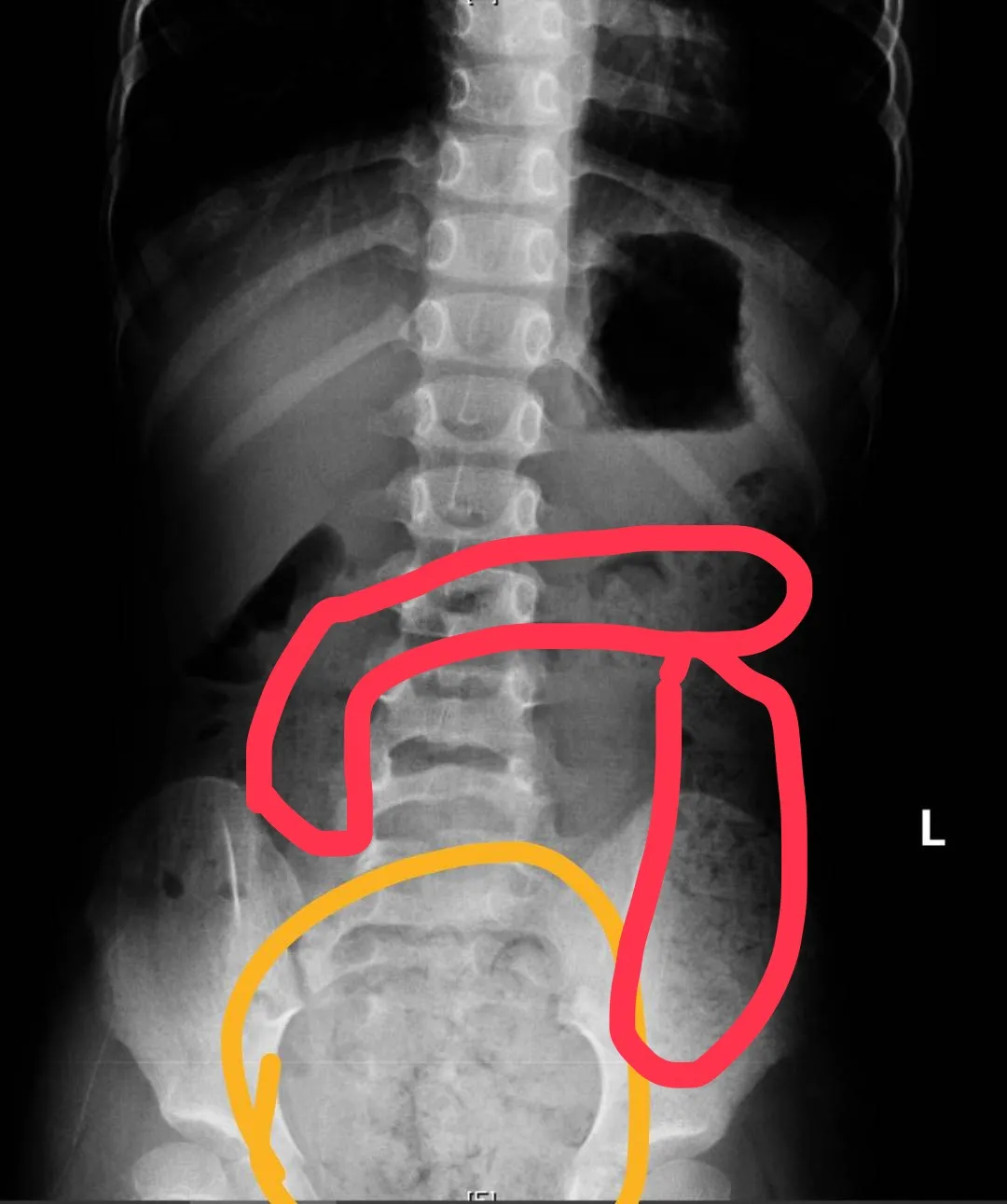 6歲女生X光片,畫圈部分為積糞。翻攝畫面