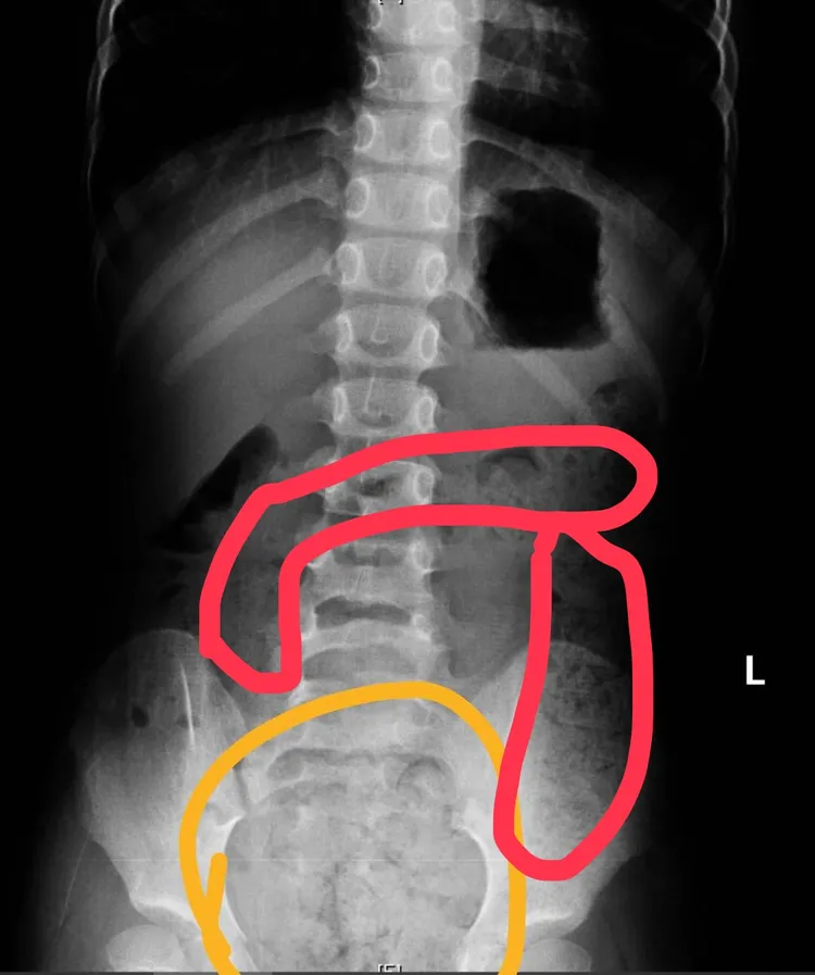 6歲女生X光片，畫圈部分為積糞。翻攝畫面