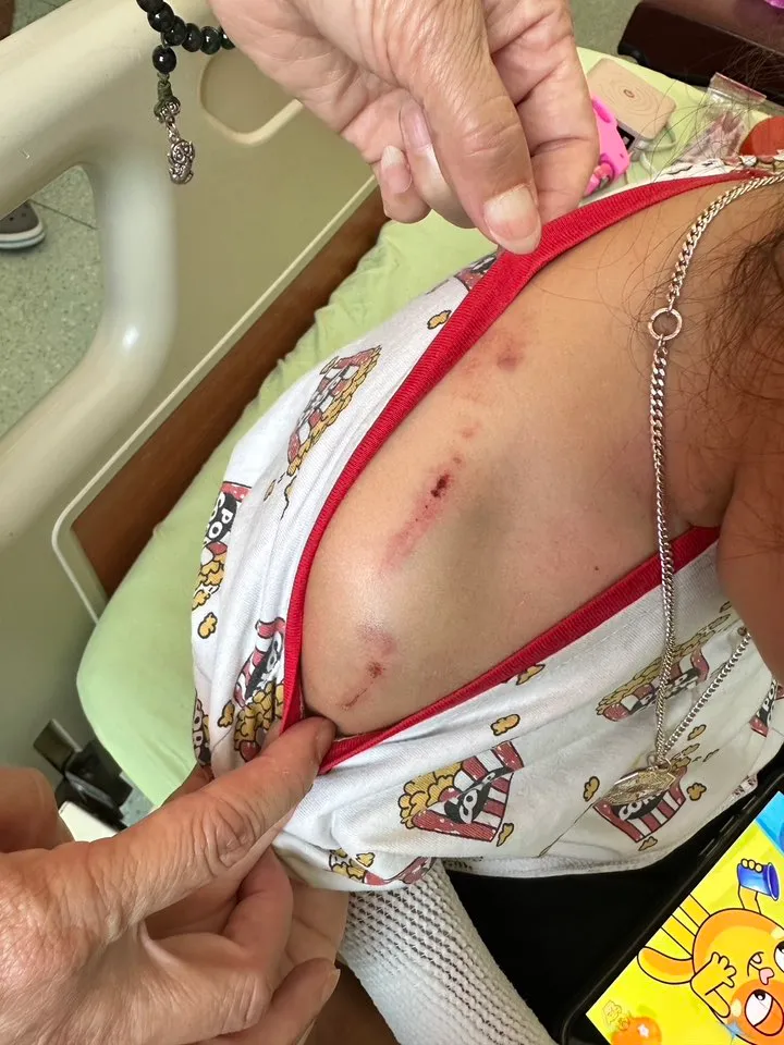 肩膀也傷痕累累。翻攝臉書「我是三義人」