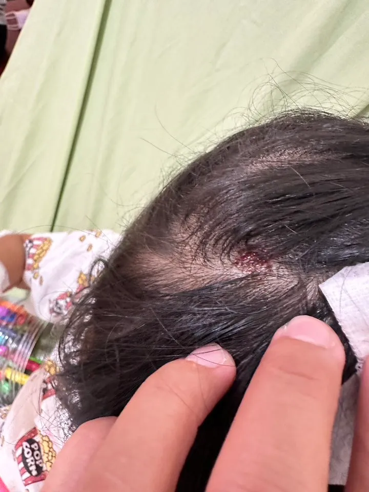 小孩頭部被咬傷。民眾提供