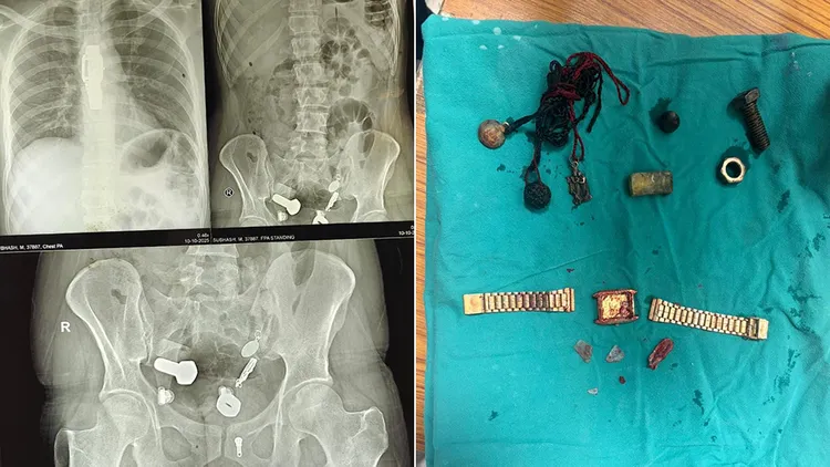 患者的X光片與取出的異物。翻攝自Hemant Kumar X
