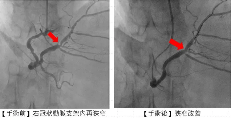 張姓患者手術前後的情況。市醫提供