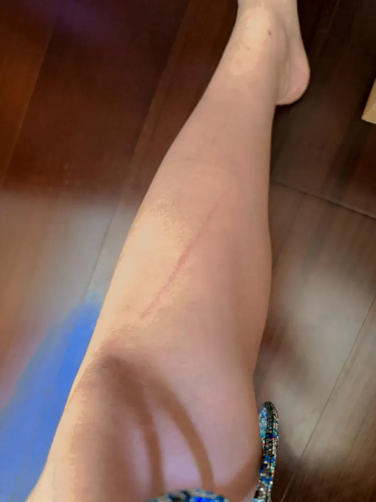 李怡貞在救災途中被尖鏟劃傷腿。翻攝「女人大律師李怡貞」臉書