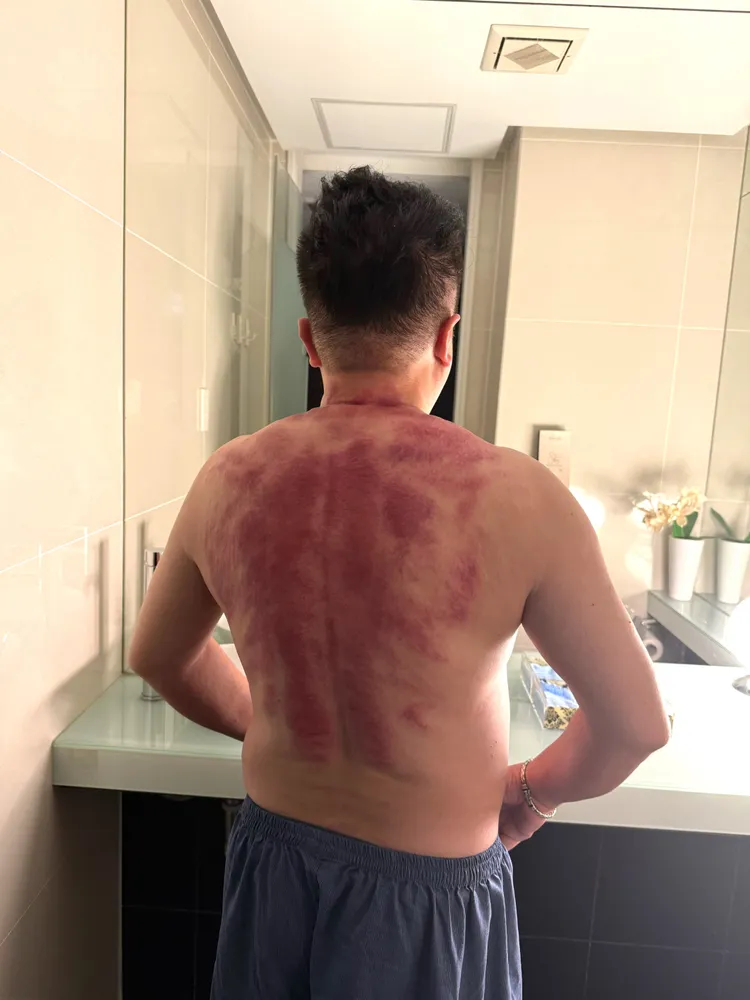 「董月花」董至成的刮痧照。新北市政府社會局提供