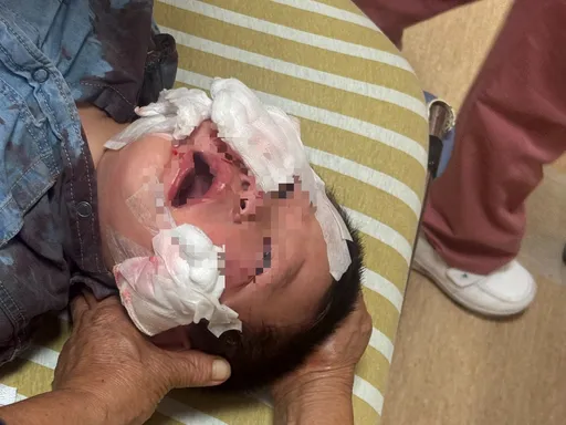 廟口吃平安宴遇襲 嘉義1歲童遭狗狠咬!小臉蛋皮開肉綻