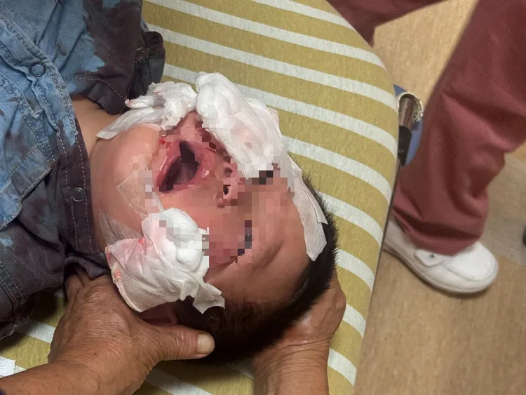 嘉义县一名1岁多男童与家人去吃平安宴,却遭到有人饲养的犬只攻击,脸部多处撕裂伤相当严重。民众提供