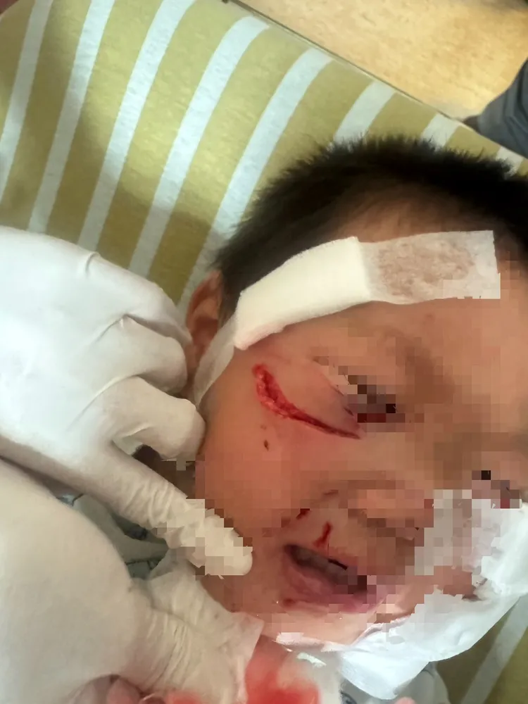 男童年幼無法打狂犬病疫苗，怕病毒感染也不能馬上縫合，只能清創觀察，家屬難過不已。民眾提供