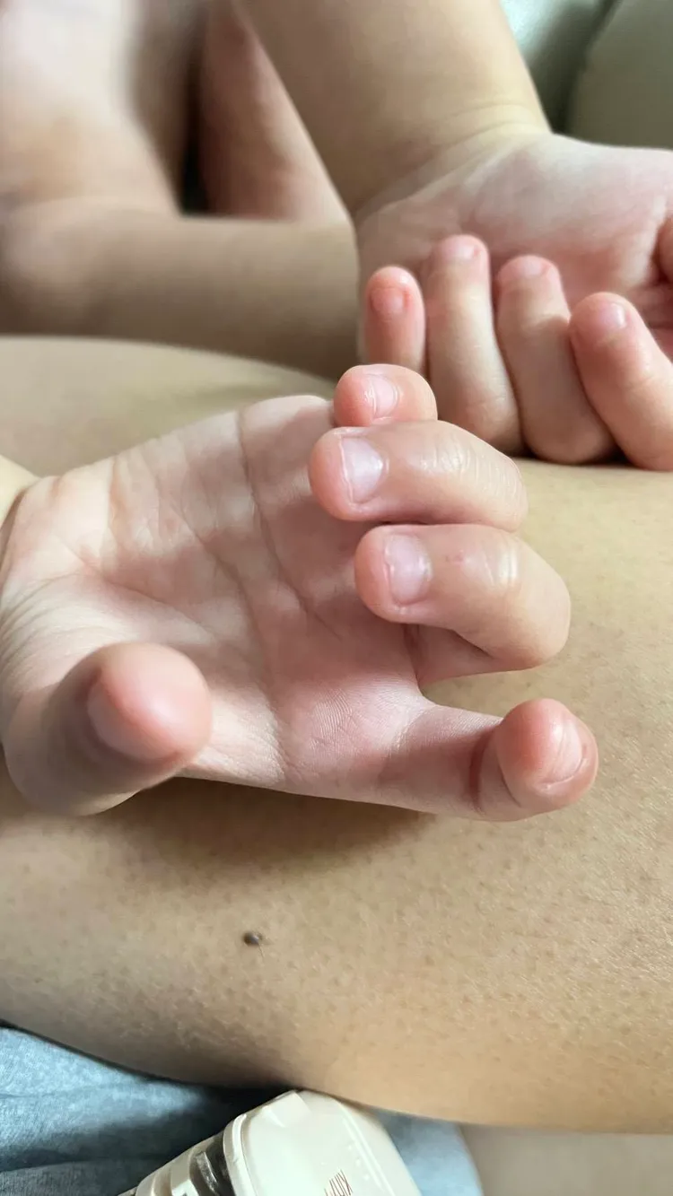 家長控訴，小朋友一焦慮就咬指甲。家長提供