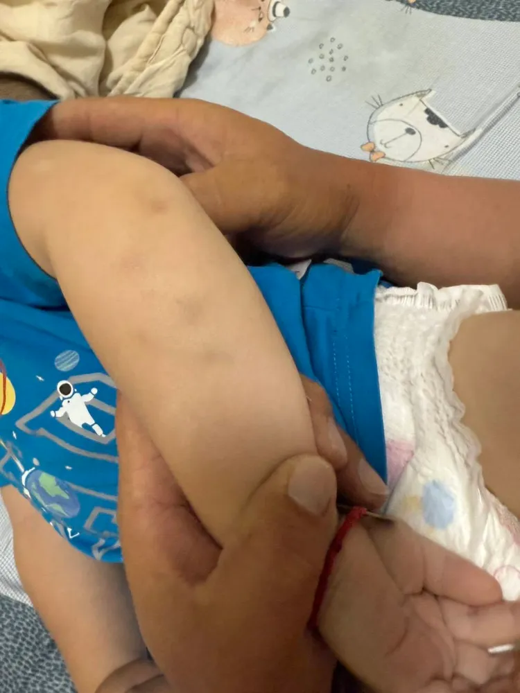 家長出示小朋友被打的傷痕。家長提供