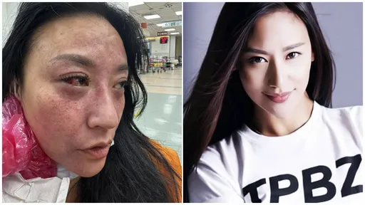 獨家｜安歆澐被老公打到「整張臉爆血管」　恐懼到吃藥才能睡