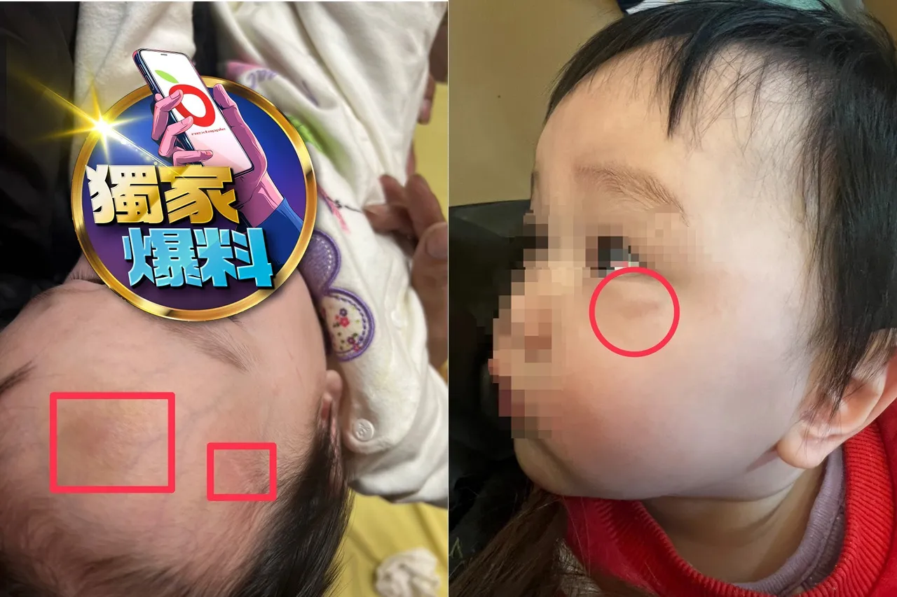 独家爆料｜1岁儿安置爆湿疹、头脸瘀青却称「被蚊子叮」　心碎母控社工扯谎！家防中心说话了