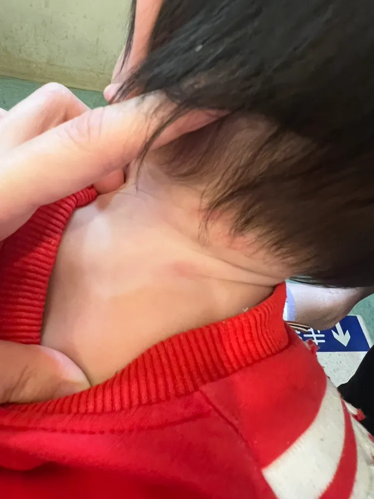 1歲幼兒右臉頰、右耳、頸部後側等多處濕疹，母親看了相當不捨，控訴兒福機構明顯照護不周，甚至涉及虐待。投訴人提供