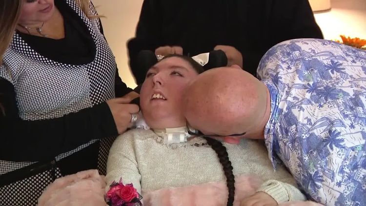 奇蹟！曾被判活不過4歲　美國「無腦女嬰」20歲了