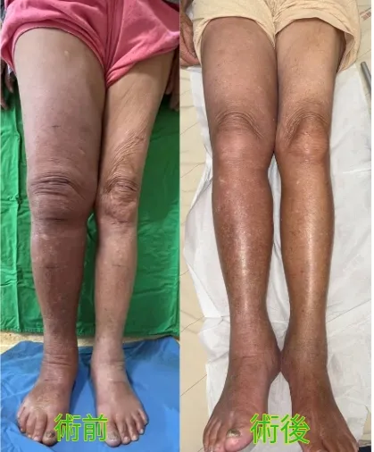 患者術前術後照片。童醫院提供