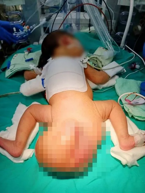 女婴出生时尾骶骨畸胎瘤已达16.5×10×8公分，有如带著1颗球来到这个世界。中港澄清提供