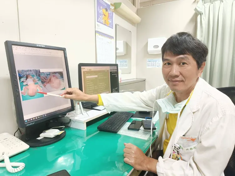 林雨利主任说，女婴出生时臀部肿瘤已达16公分，所幸是良性的尾骶骨畸胎瘤，切除后目前顺利成长。中港澄清提供