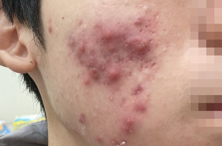 高三生熬夜苦讀慘變滿臉痘痘 原來是炸物、手搖飲惹的禍