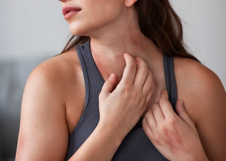 秋天皮膚容易乾癢。示意圖