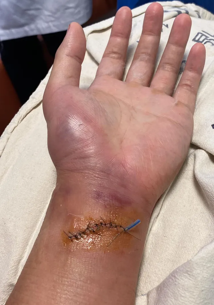 陳譽被逼車惡煞鄭順翔砍傷左手前臂後縫合的傷口。翻攝陳譽老師臉書