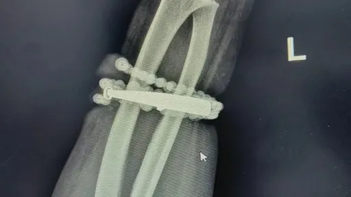 她戴手镯10年没取下　发福后「长进肉里」严重感染