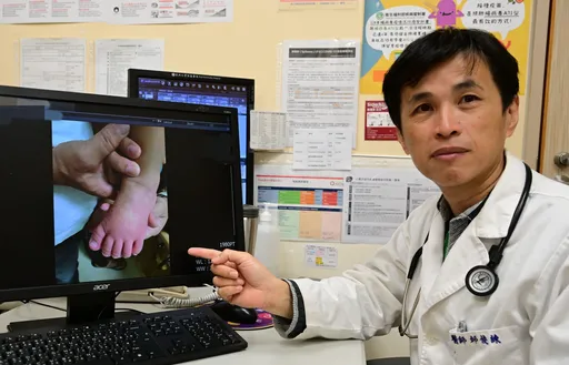 2歲童雙眼充血燒不停！手腳「腫成麵龜」　原來是川崎症惹禍