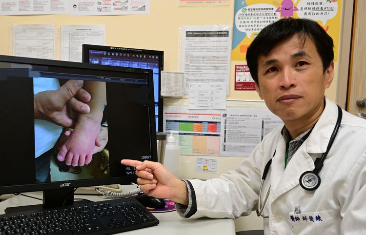 2歲童雙眼充血燒不停！手腳「腫成麵龜」　原來是川崎症惹禍