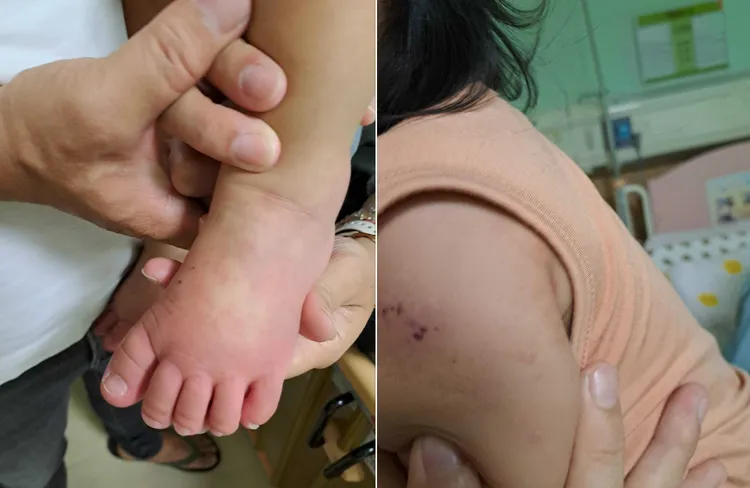 病童就醫時出現連日高燒不退、手腳末端紅腫以及多形性皮疹等川崎症症狀。亞大附醫提供