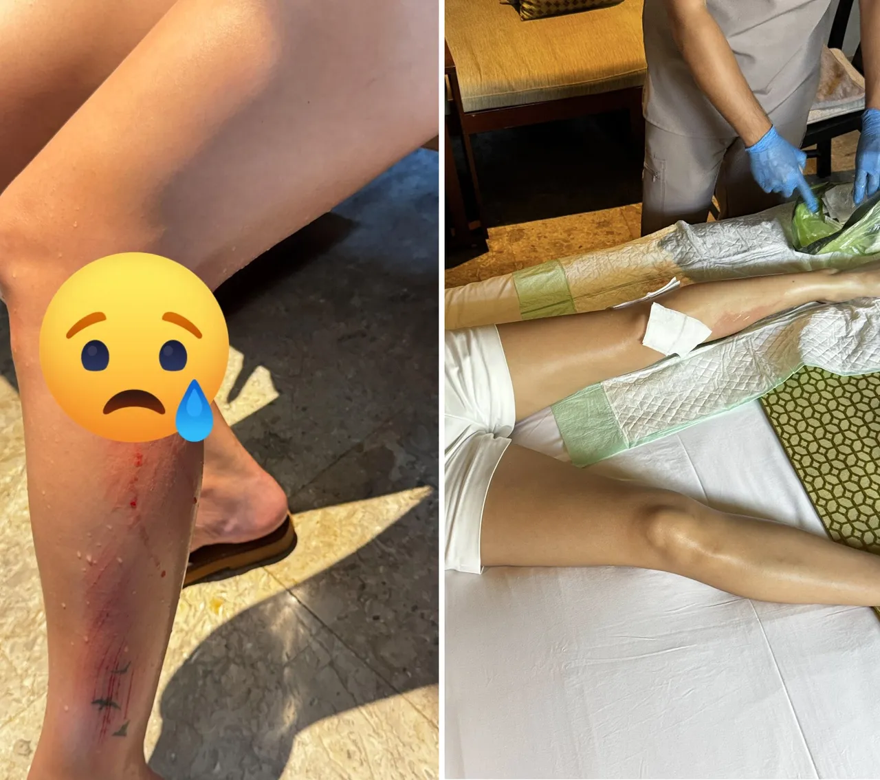 岳启儒曝光在峇里岛SPA踩空卡腿的伤势。翻摄自岳启儒脸书