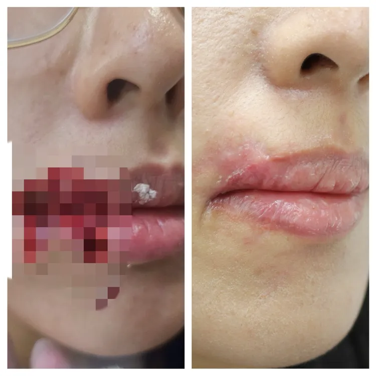 28岁妙龄女被爱犬咬掉嘴边肉，丰原医院以美容缝合及PRP（自体血小板血浆）增生疗法」，顺利修复其脸部。丰医提供