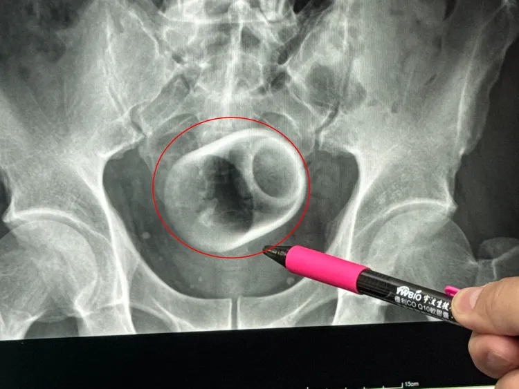一名男子把陶瓷杯塞進肛門，X光片顯示杯子位於骨盆腔內。李綜合提供