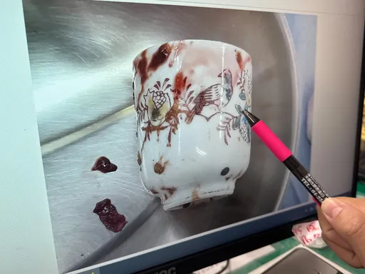 怪癖男「肛門塞茶杯」3天無法解便　醫緊急開刀取出