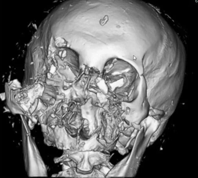 熊襲受害者鼻樑斷裂、眼球飛出，顏面9成損傷。翻攝自X