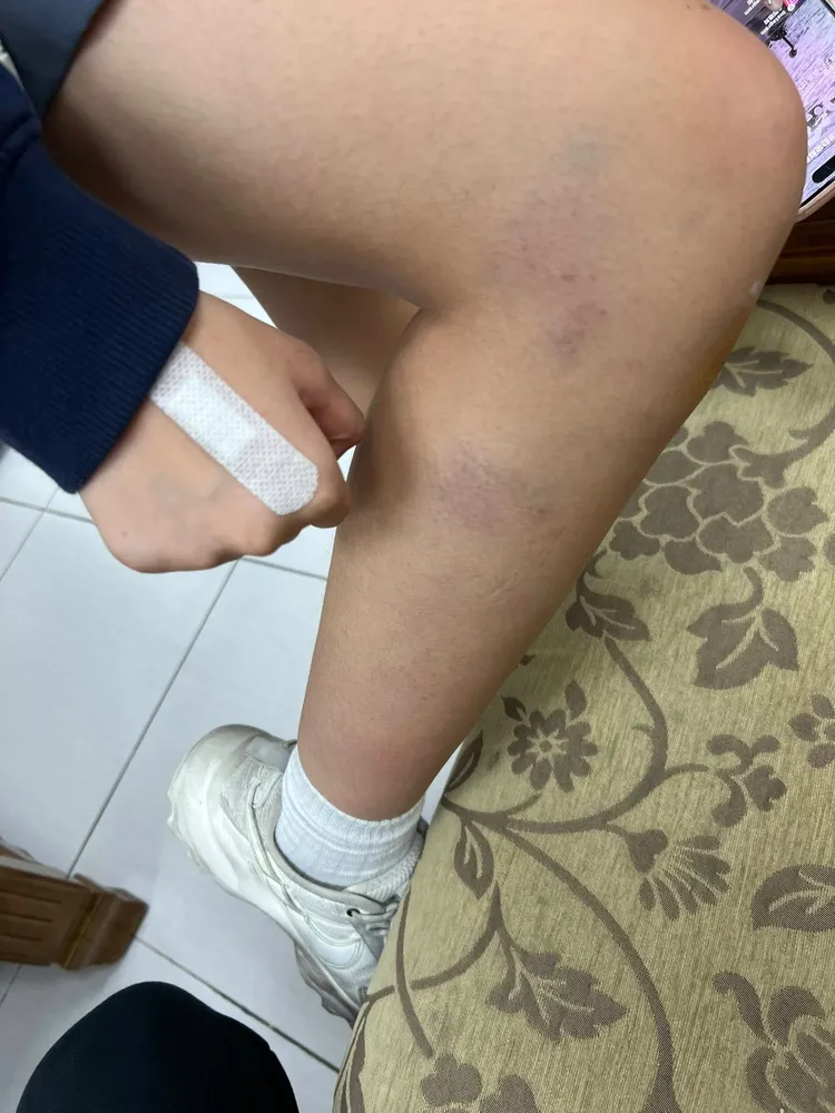 女學生在被拖行的過程中，身上也留下明顯擦挫傷。翻攝我是新莊人許明偉臉書