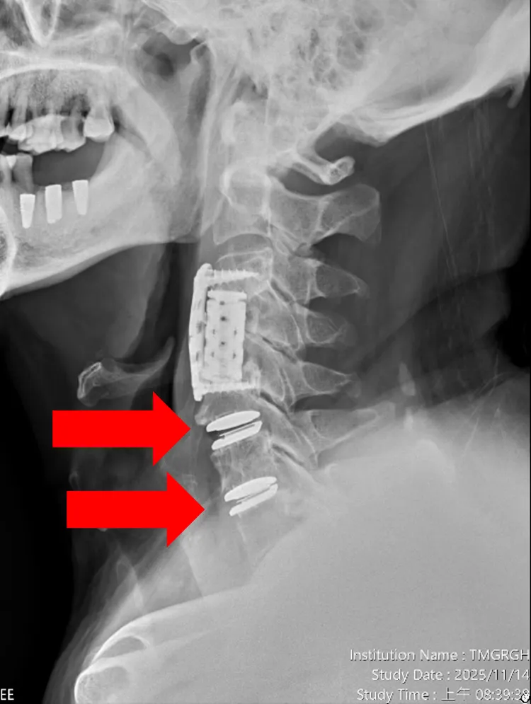 患者的第五第六及第六第七頸椎間盤切除，並植入人工椎間盤，症狀大幅改善。院方提供