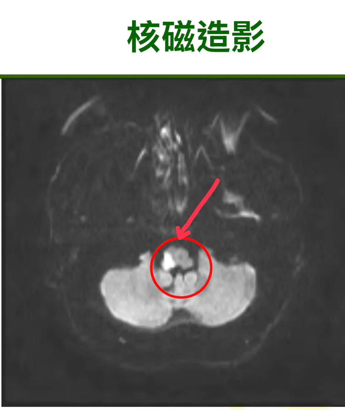 核磁共振影像显示，患者脑干右侧（白色反光处）血管阻塞。台中医院提供