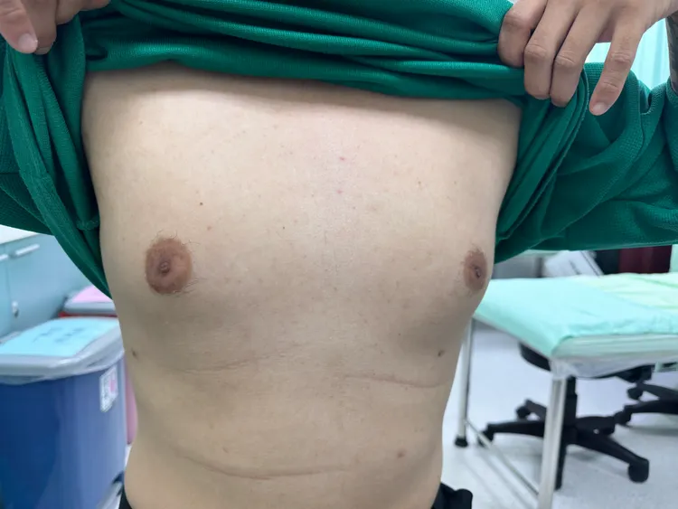 乌日林新医院以微创腋下抽脂手术，为张先生解决男性女乳症困扰。院方提供