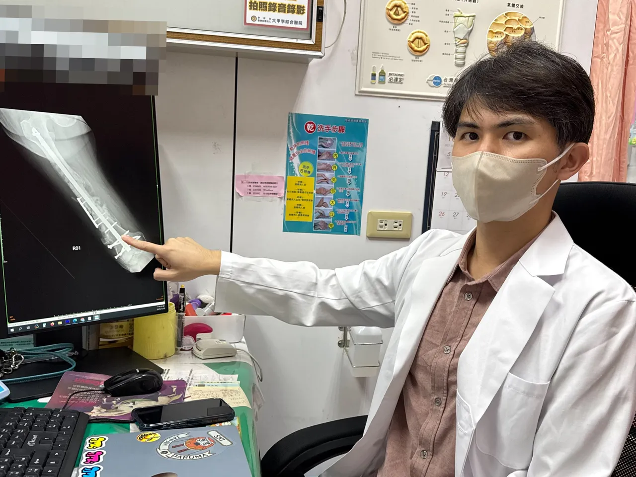 患者因钢板金属疲劳断裂，骨科医师廖唯任使用髓内钢钉为患者固定大腿。李综合提供