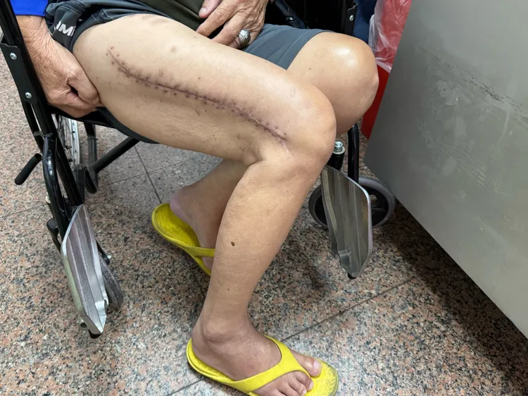 大甲妈头旗队82岁的王姓副团长，因车祸导大腿骨断3截，后来用髓内钢钉固定已能站立。李综合提供