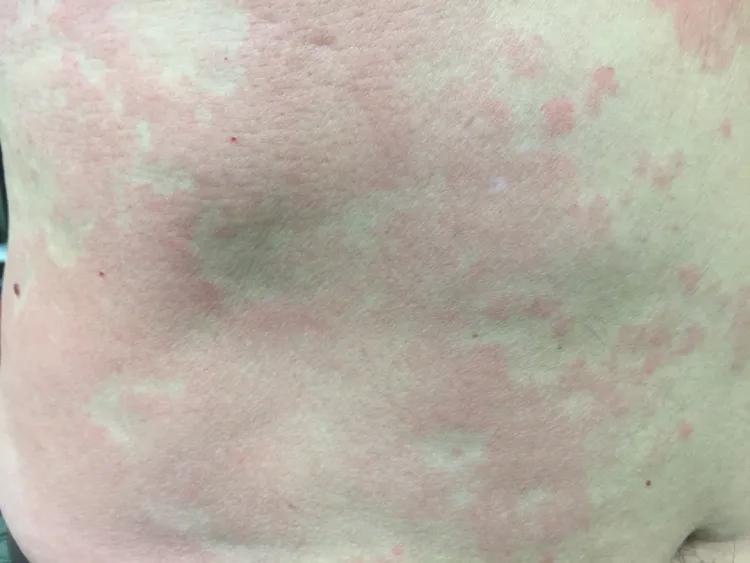 慢性自发性荨麻疹。台大医院朱家瑜医师提供