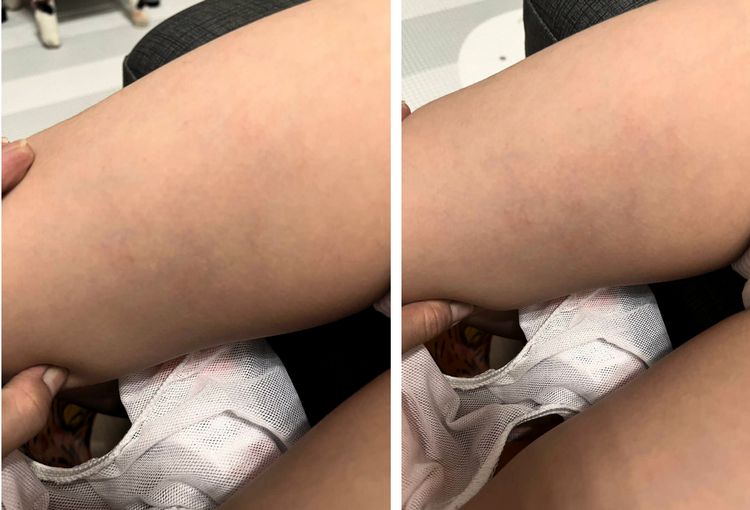 北市特教學童遭隨車教保員痛毆瘀青　校方常年擺爛被抓包