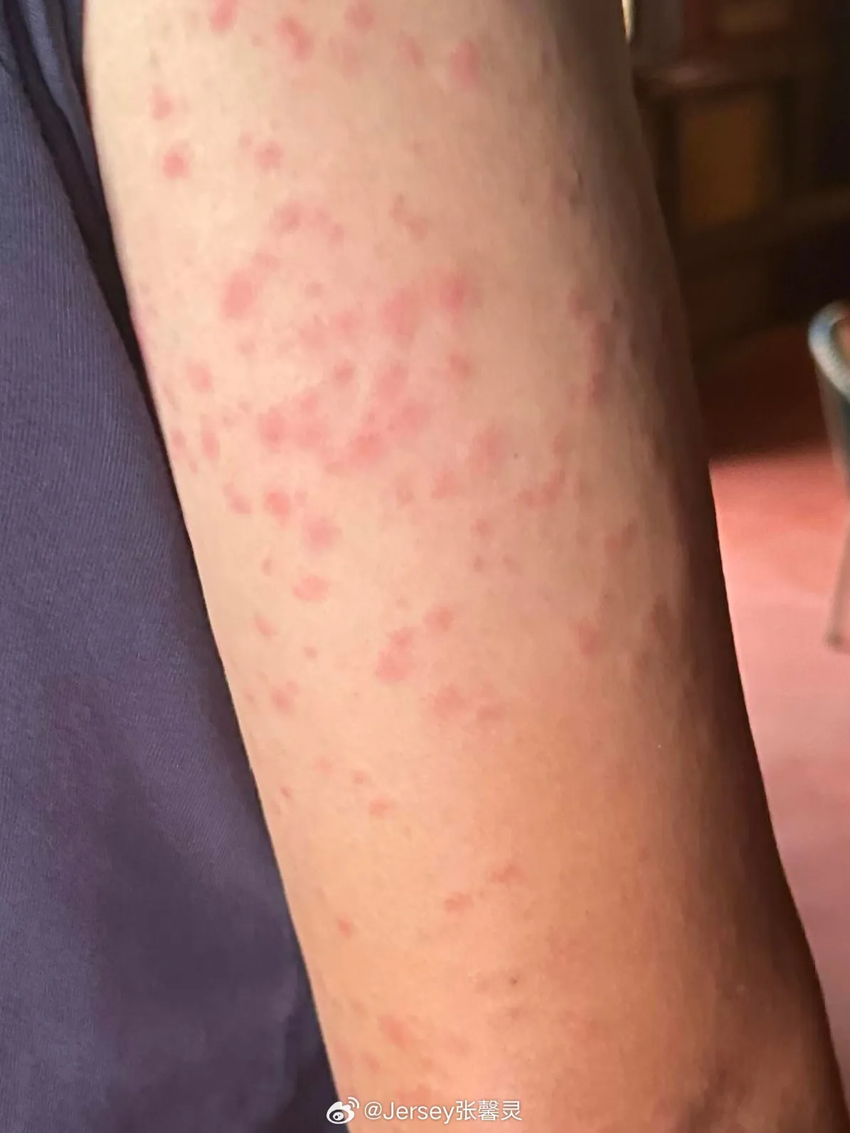 范冰冰手臂被蚊子咬成紅豆冰。翻攝張馨靈微博