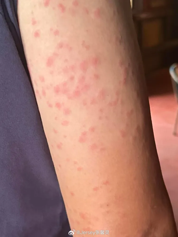 范冰冰手臂被蚊子咬成紅豆冰。翻攝張馨靈微博