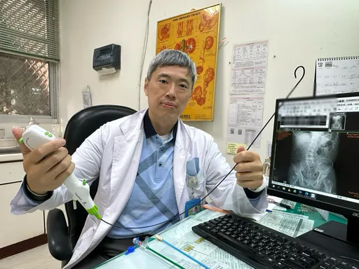 传产老董「咖啡尿」惊见1.8公分结石　雷射碎石手术救肾保命