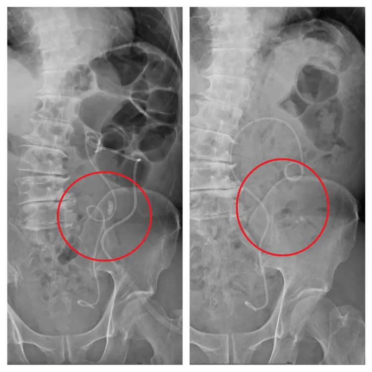 患者輸尿管卡了1顆1.8公分的結石。院方提供