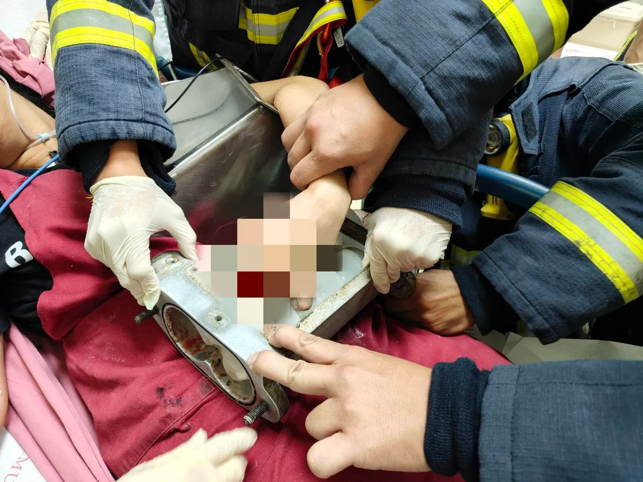 消防人员拆卸大部零件，将手部卡住的部分一起送往医院处理。翻摄照片